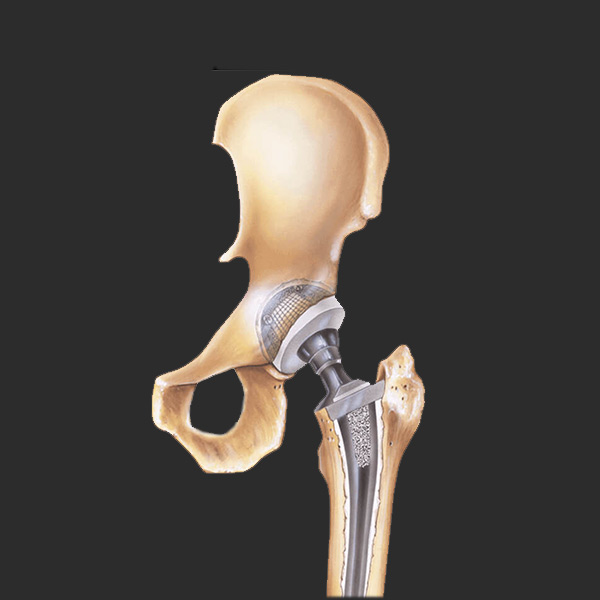 Total Hip Replacement Image